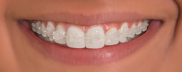 Ortodoncia estética autoligable